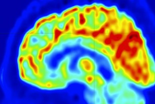 UVA Develops Imaging Approach to Help Stop Epilepsy Seizures