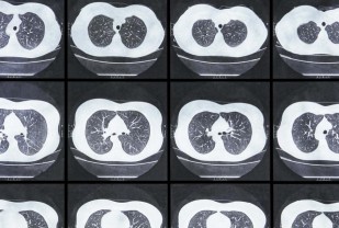 Lung Cancer: UVA Health Expert Helps Develop New National Screening Guidelines