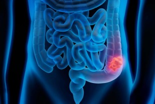 Strange Colon Discovery Explains Racial Disparities in Colorectal Cancer