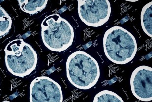 Epilepsy Discovery Reveals Why Some Seizures Prove Deadly