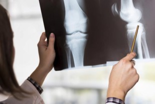 Osteoporosis: New Approach to Understanding Bone Strength Pays Dividends