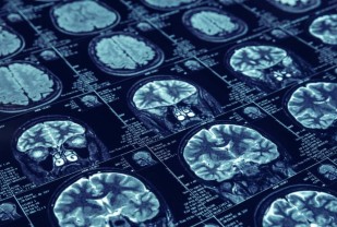 New Stroke Guidelines Aim to Improve Care Amid COVID-19