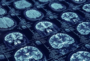 New Stroke Guidelines Aim to Improve Care Amid COVID-19