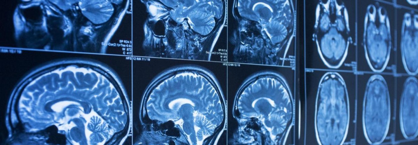 Targeting Calcium Overload Could Improve Stroke Outcomes, UVA Research Suggests