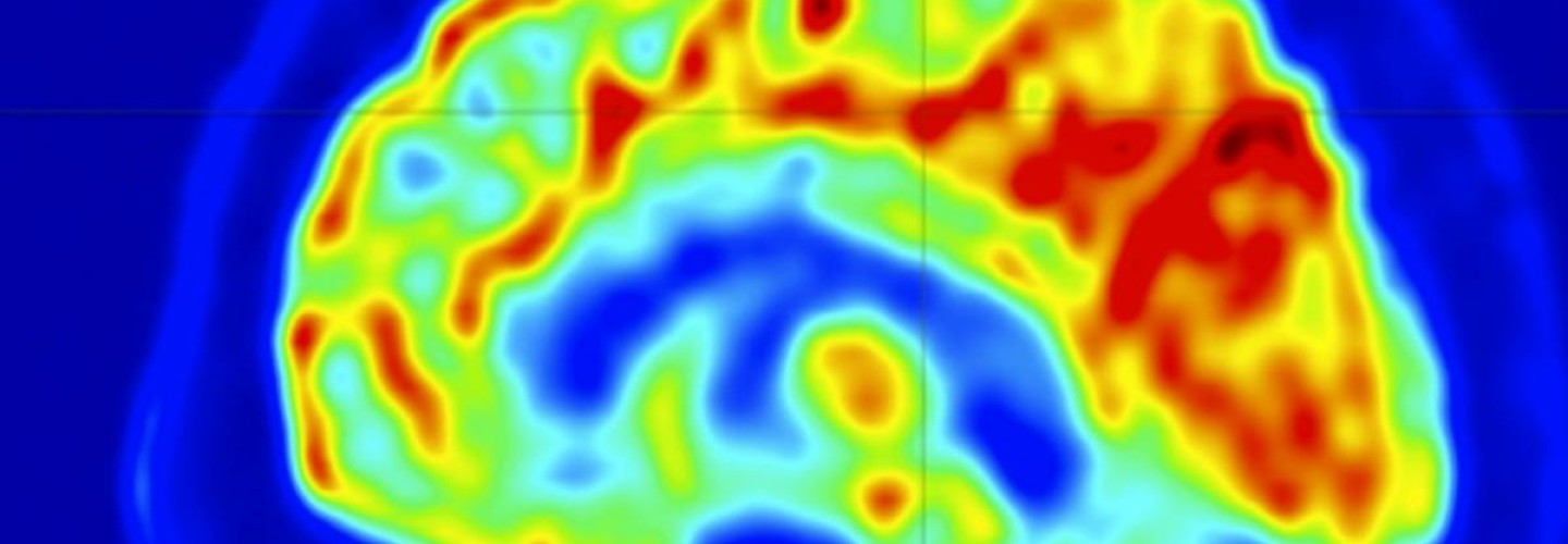 UVA Develops Imaging Approach to Help Stop Epilepsy Seizures