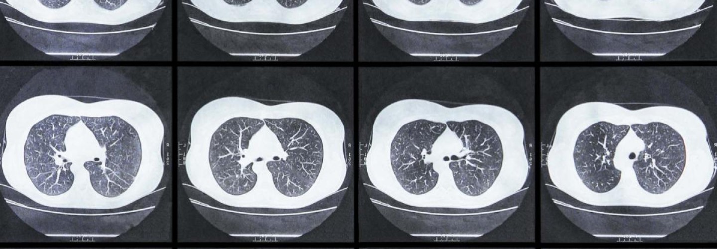 Lung Cancer: UVA Health Expert Helps Develop New National Screening Guidelines
