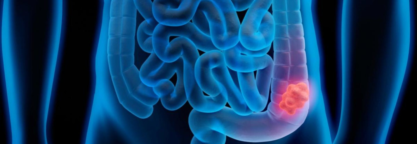 Strange Colon Discovery Explains Racial Disparities in Colorectal Cancer