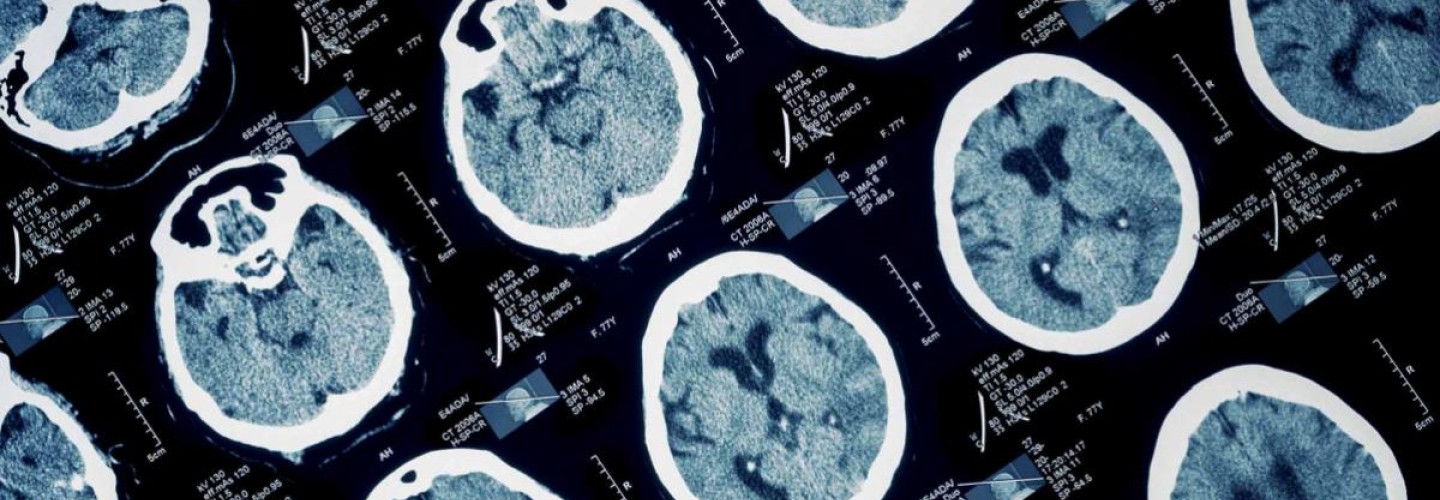Epilepsy Discovery Reveals Why Some Seizures Prove Deadly