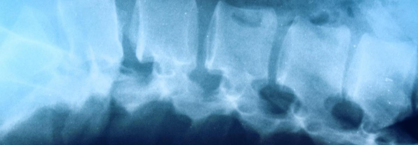 Spinal Cord Injuries: UVA Scientists Probe Individual Cells to Find Better Treatments