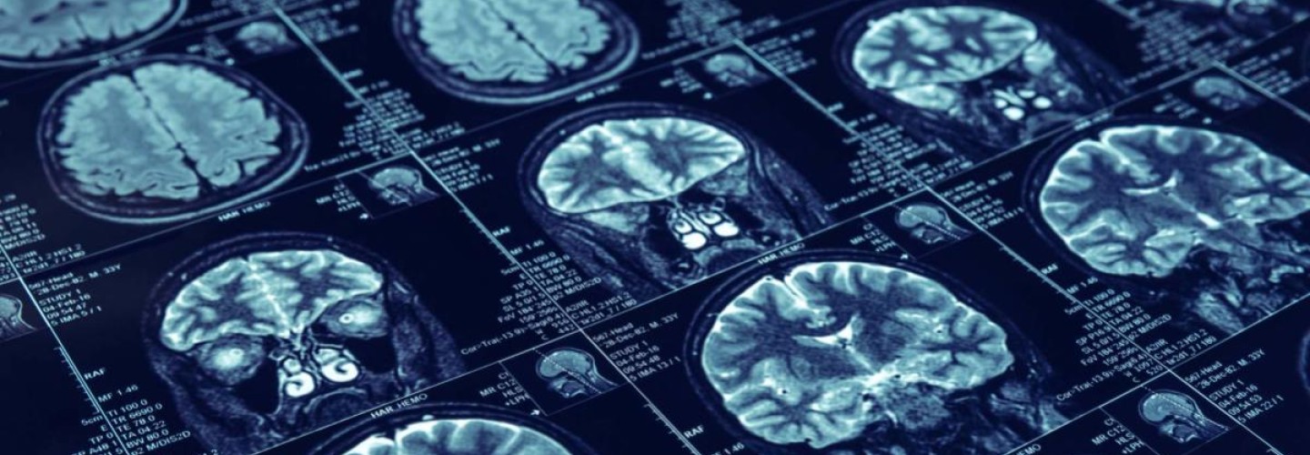 New Stroke Guidelines Aim to Improve Care Amid COVID-19
