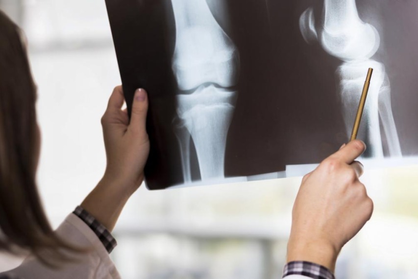 The research reveals the bone-related functions of several genes not previously known to influence bone density and, ultimately, our risk of fracture.